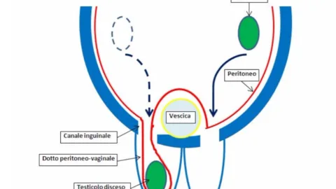 ernia inguinale benvenuti