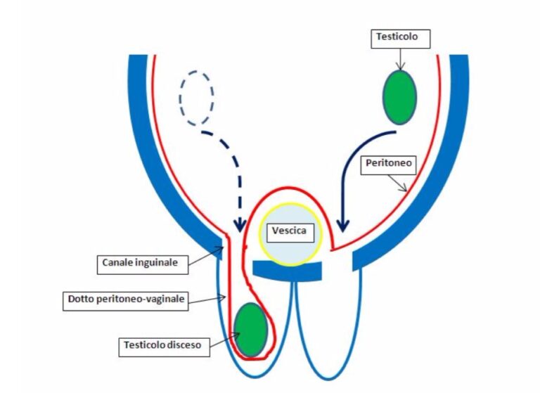 L’ernia inguinale nel bambino