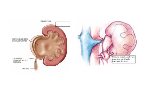 idronefrosi-nel-bambino-benvenuti