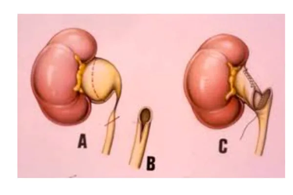 idronefrosi-nel-bambino-benvenuti