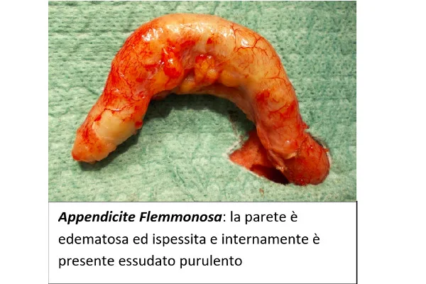 L’appendicite appendicite-articolo-benvenuti-per-bresciabimbi