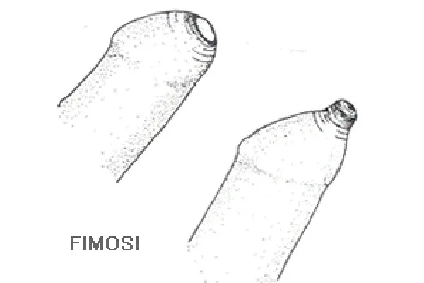 fimosi-nel-bambino-articolo-benvenuti-per-bresciabimbi