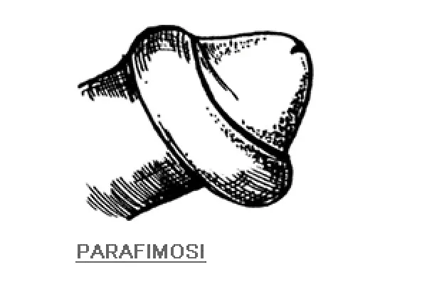 fimosi-nel-bambino-parafimosi-articolo-benvenuti-per-bresciabimbi