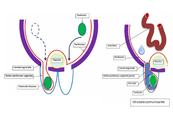 idrocele-nel-bambino-articolo-benvenuti-per-bresciabimbi