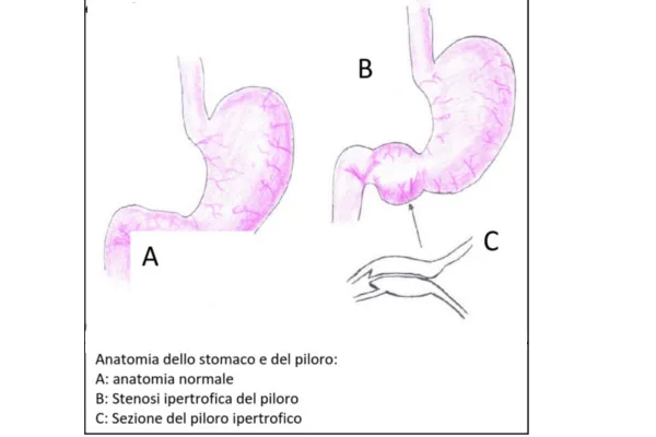 stenosi-ipetrofica-del-piloro-articolo-benvenuti-per-bresciabimbi