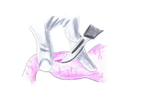 stenosi-ipetrofica-del-piloro-incisione-articolo-benvenuti-per-bresciabimbi